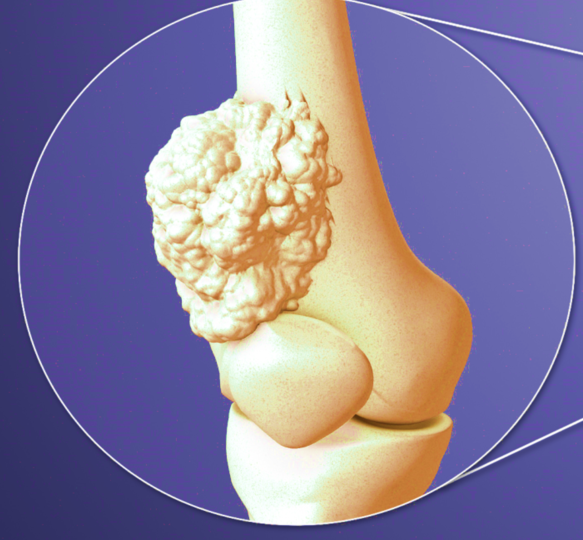 Bone and Soft Tissue Oncology