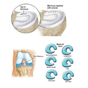 Meniscal Repair