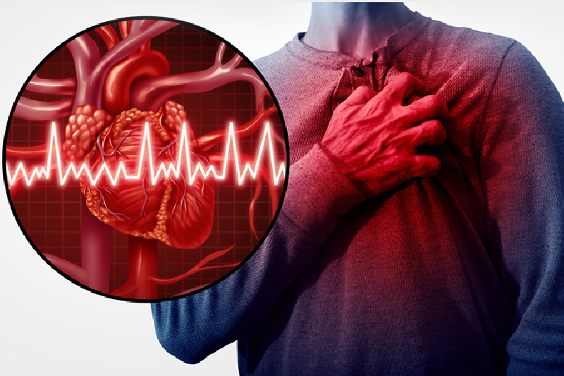 What Is Heart Attack or Myocardial Infarction (MI)- Lucknow Apollo Hospitals