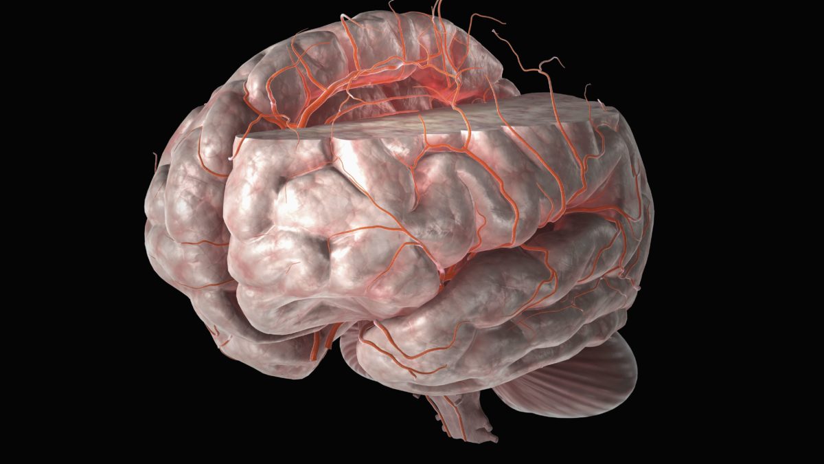 What is Acute Ischemic Stroke or Brain Stroke?